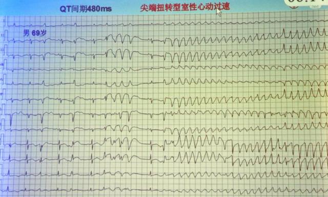 短QT间期综合征(图3) 短QT间期综合征_双色球综合走势图近30期_3d天牛图库综合彩报311期