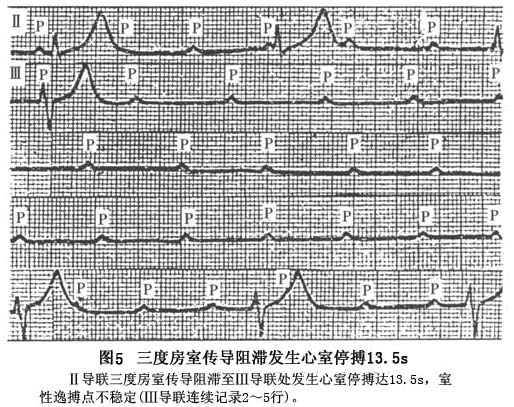短QT间期综合征(图4) 3d天牛图库综合彩报311期_双色球综合走势图近30期_短QT间期综合征