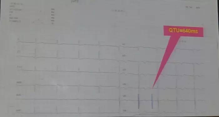 【SCC 2017】朱俊:获得性长QT间期综合征的诊断与处理(图2) 长QT间期综合征