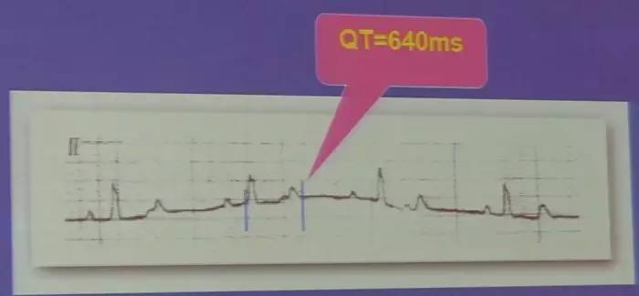 【SCC 2017】朱俊:获得性长QT间期综合征的诊断与处理(图3) 长QT间期综合征