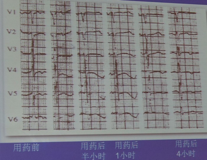 【SCC 2017】朱俊:获得性长QT间期综合征的诊断与处理(图5) 长QT间期综合征