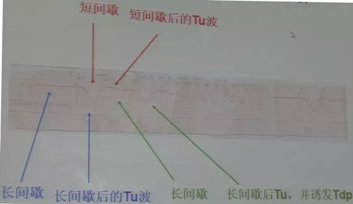 【SCC 2017】朱俊:获得性长QT间期综合征的诊断与处理(图6) 长QT间期综合征