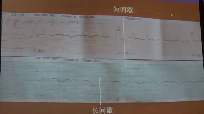【SCC 2017】朱俊:获得性长QT间期综合征的诊断与处理(图8) 长QT间期综合征