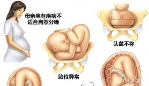 多胎妊娠减胎注意事项_多胎妊娠_单胎妊娠是什么意思