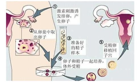 辅助生殖