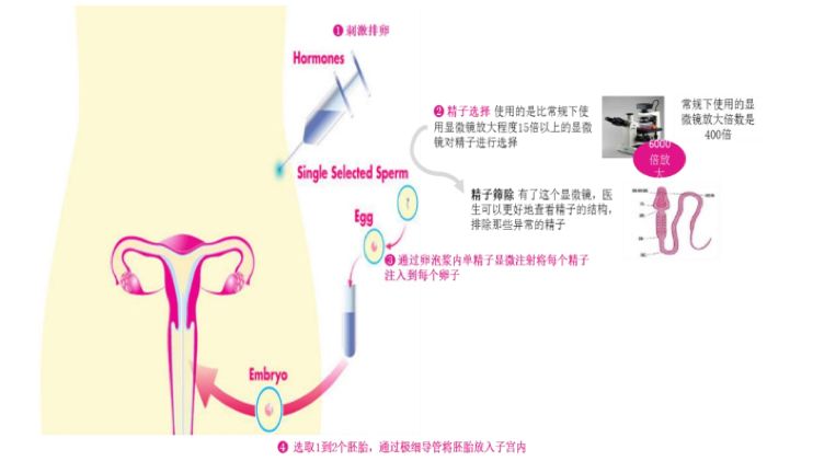 辅助生殖