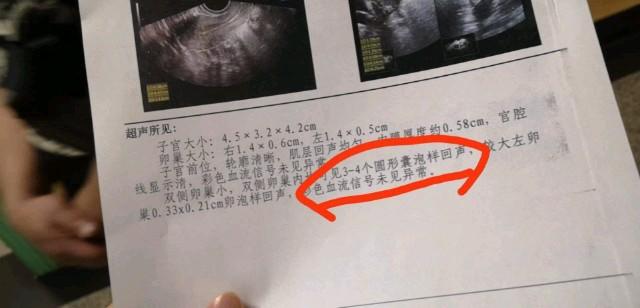 窦卵泡计数_多囊卵巢窦状卵泡_穿刺大卵泡,小卵泡能长大吗