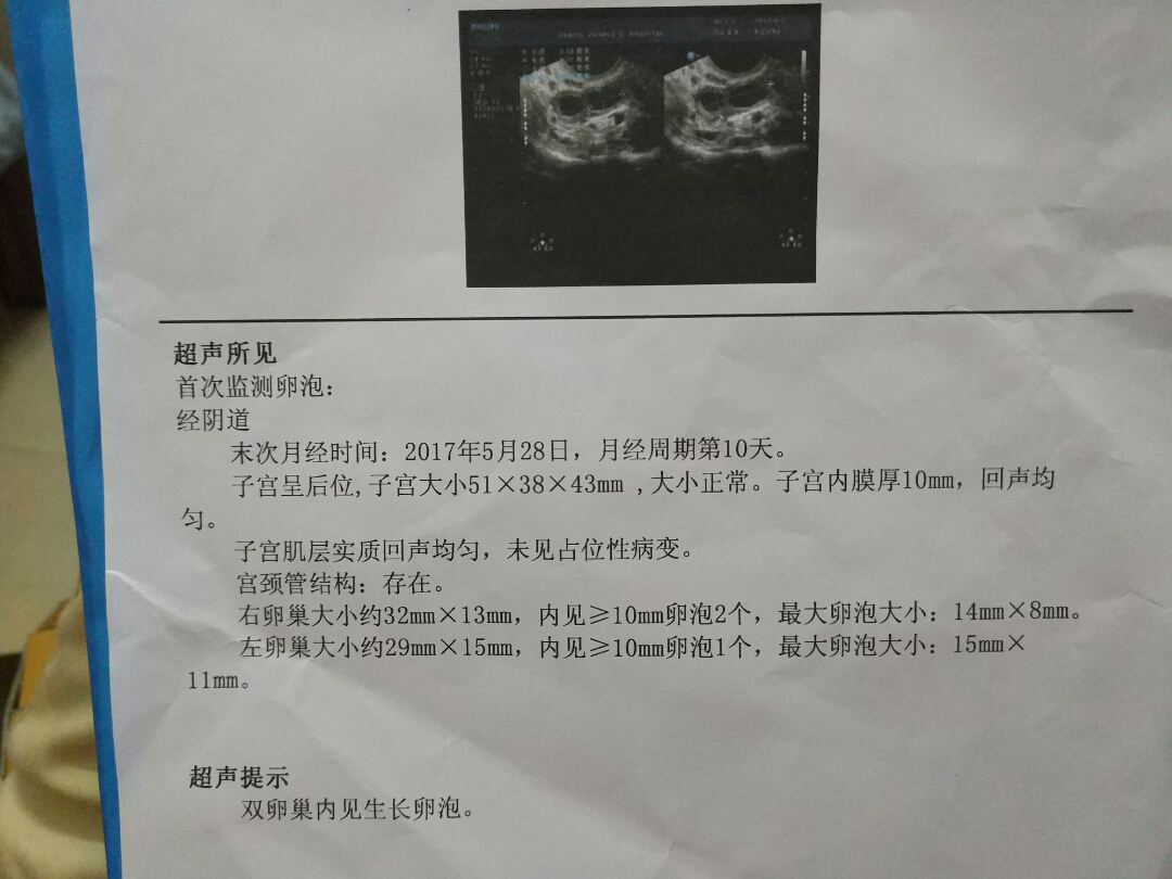 窦卵泡计数_多囊卵巢窦状卵泡_穿刺大卵泡,小卵泡能长大吗