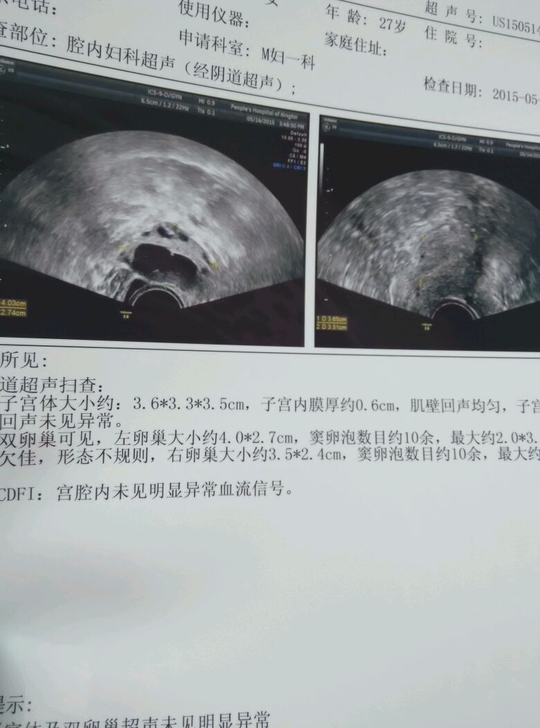 穿刺大卵泡,小卵泡能长大吗_多囊卵巢窦状卵泡_窦卵泡计数