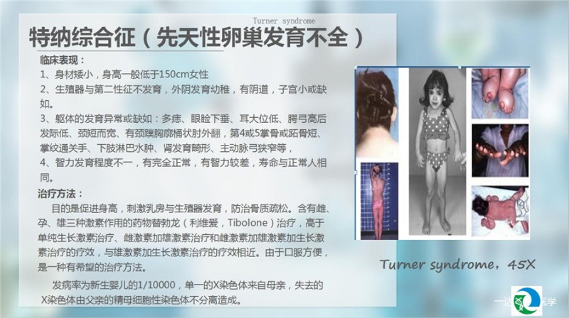 特纳氏综合症_特纳氏综合症 病因_特纳氏综合症的原因