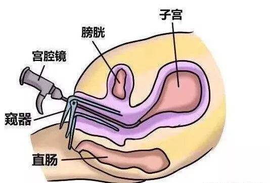 宫腔环境检查