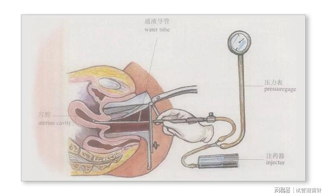 白带清洁度3能做宫腔镜检查吗?_宫腔环境检查_北京复兴医院宫腔镜检查
