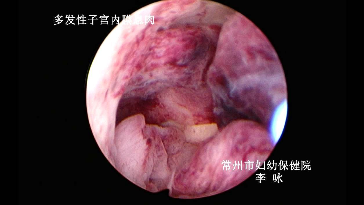 什么情况做宫腔镜检查_宫腔镜检查_什么是宫腔镜检查
