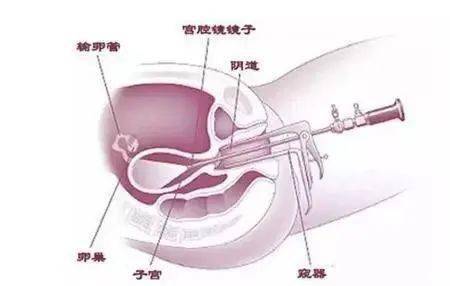 宫腔镜检查_什么是宫腔镜检查_什么情况做宫腔镜检查