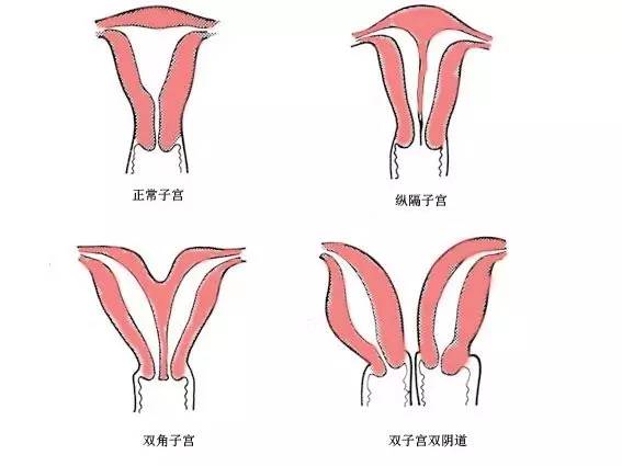 什么情况做宫腔镜检查_宫腔镜检查_什么是宫腔镜检查