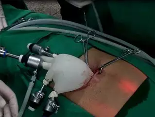 什么情况做宫腔镜检查_宫腔镜检查_什么是宫腔镜检查