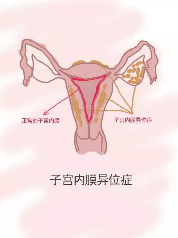 子宫内膜薄_子宫n内膜弥漫型小息肉_子宫没有内膜有月经吗