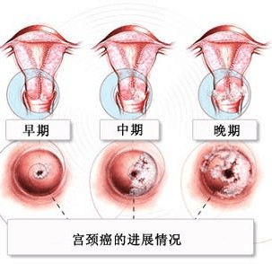 宫腔镜检查术_宫腔镜检查_什么情况做宫腔镜检查