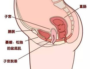 盆底肌康复训练_盆底肌修复_盆底肌康复有用吗