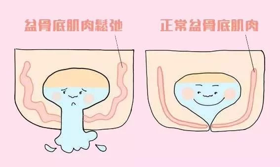 盆底肌修复