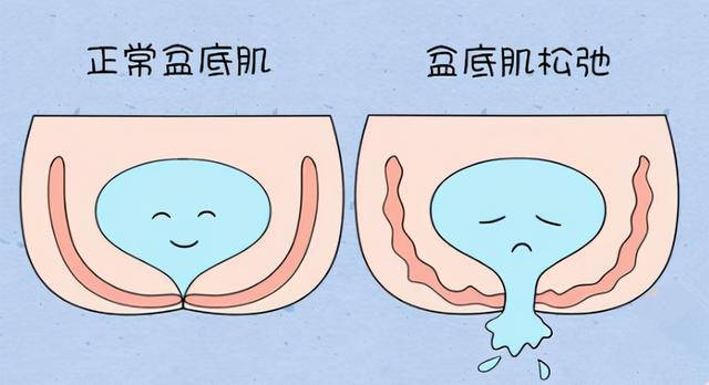 盆底肌康复训练_盆底肌康复有用吗_盆底肌修复