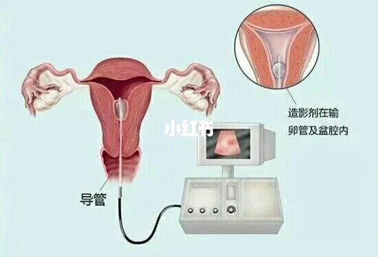 输卵管造影_造影可以疏通输卵管吗_造影疏通输卵管吗