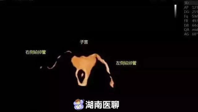 输卵管造影