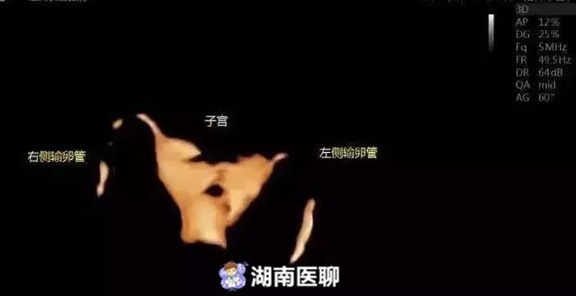 输卵管造影
