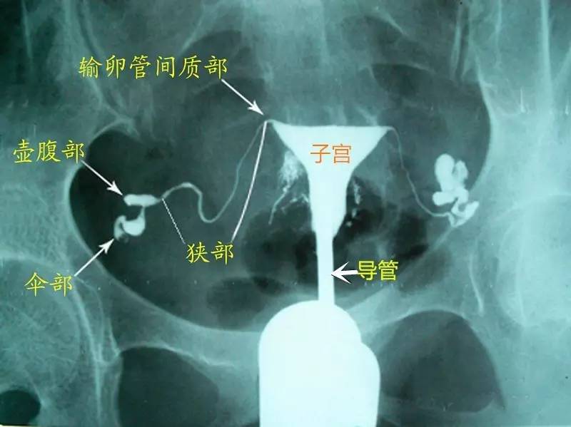 输卵管造影_造影疏通输卵管吗_输卵管超声造影疼不疼