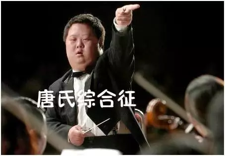 唐氏综合症