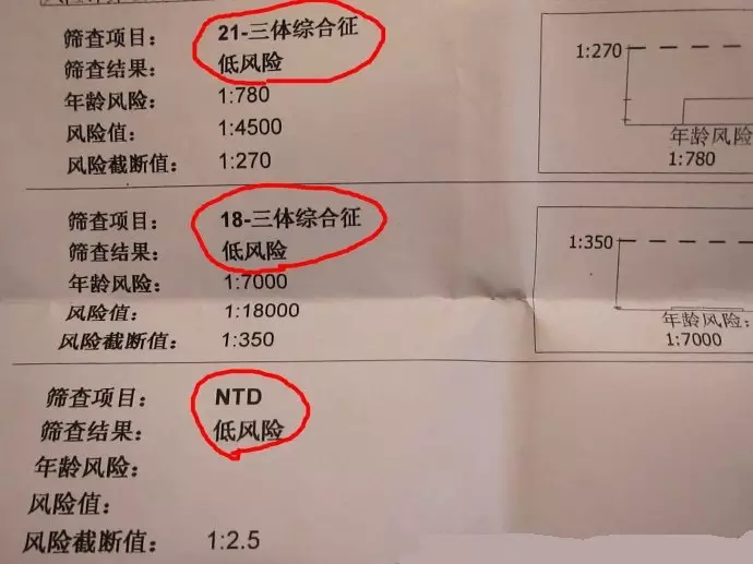 唐氏综合症
