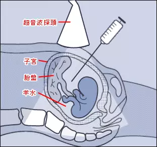 唐氏综合症