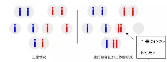 唐氏综合症