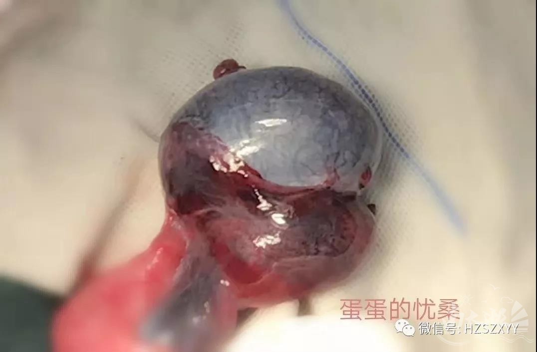 睾丸扭转_睾丸扭转原因_急性睾丸扭转