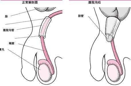 睾丸扭转_睾丸扭转原因_急性睾丸扭转