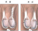 睾丸扭转