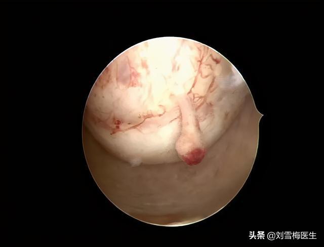 北京复兴医院宫腔镜检查_宫腔镜检查术_宫腔环境检查