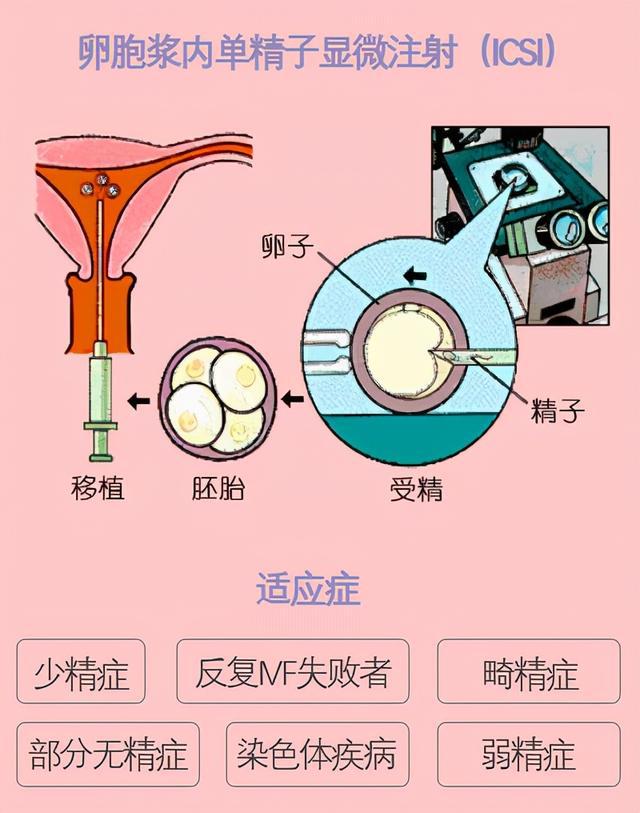 辅助生殖哪个便宜_便宜的辅助生殖医院是哪家_辅助生殖