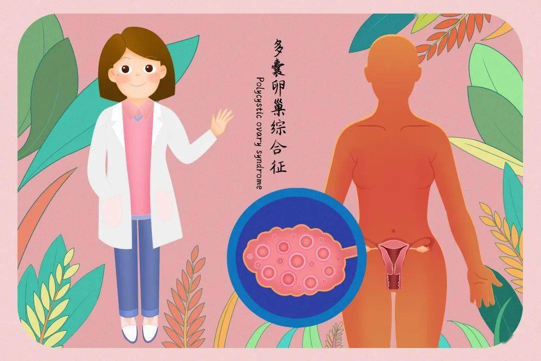 多囊卵巢