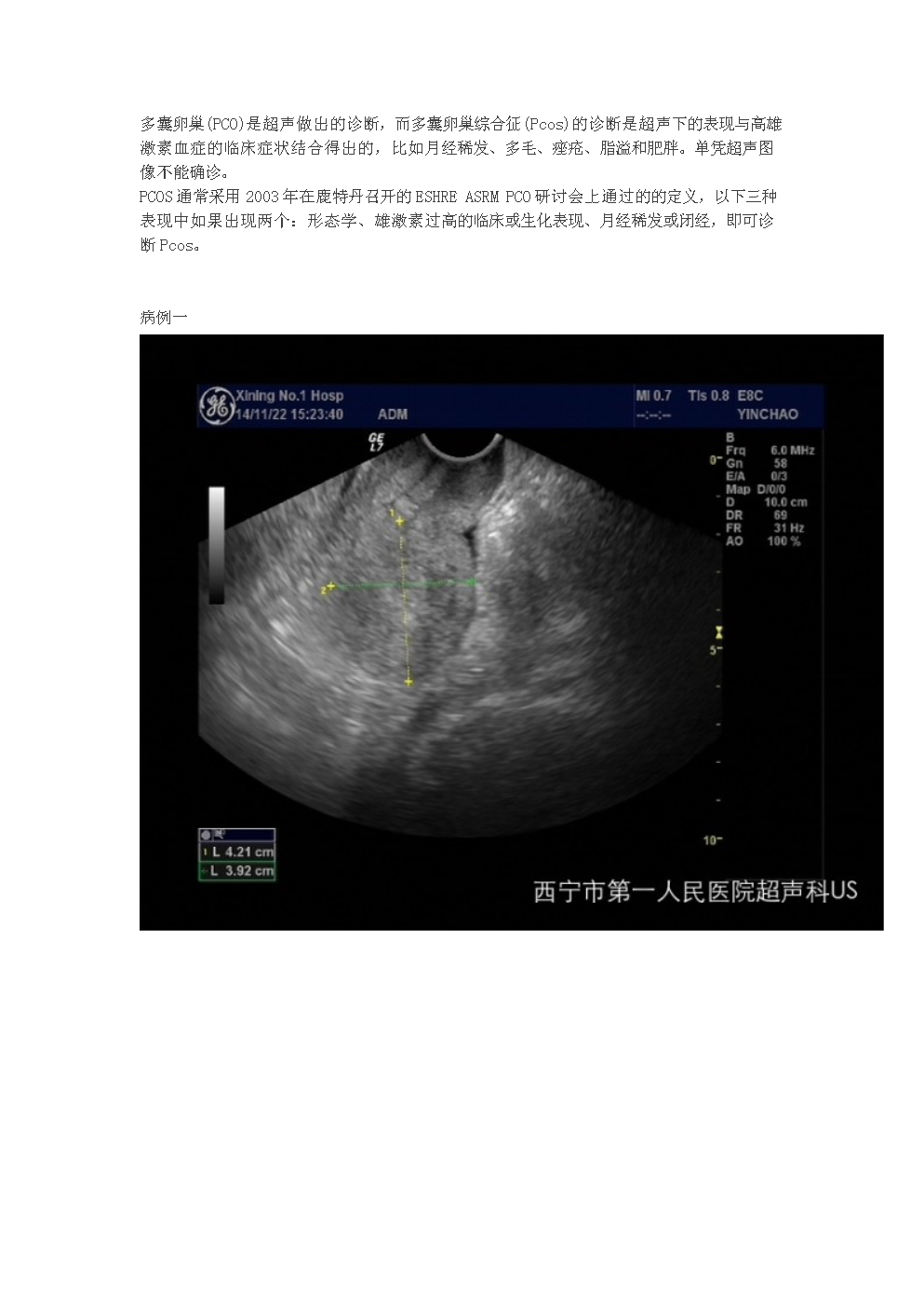 多囊卵巢 卵巢增大_多囊卵巢症_多囊卵巢