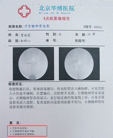 多囊卵巢 卵巢增大_多囊卵巢_多囊卵巢症