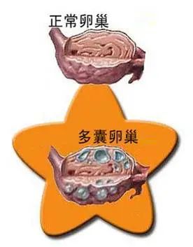多囊卵巢