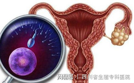 多囊卵巢_多囊卵巢就一个囊_怎么治疗多囊卵巢
