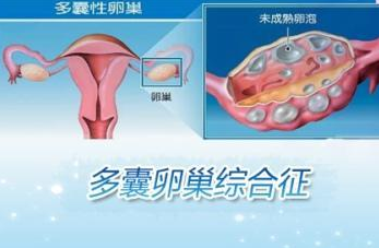 多囊卵巢就一个囊_多囊卵巢_怎么治疗多囊卵巢