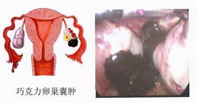 脚踝 囊肿 微波理疗仪 治疗囊肿_巧克力囊肿_可拉奥巧克力榛子瓦巧克力夹心蛋卷