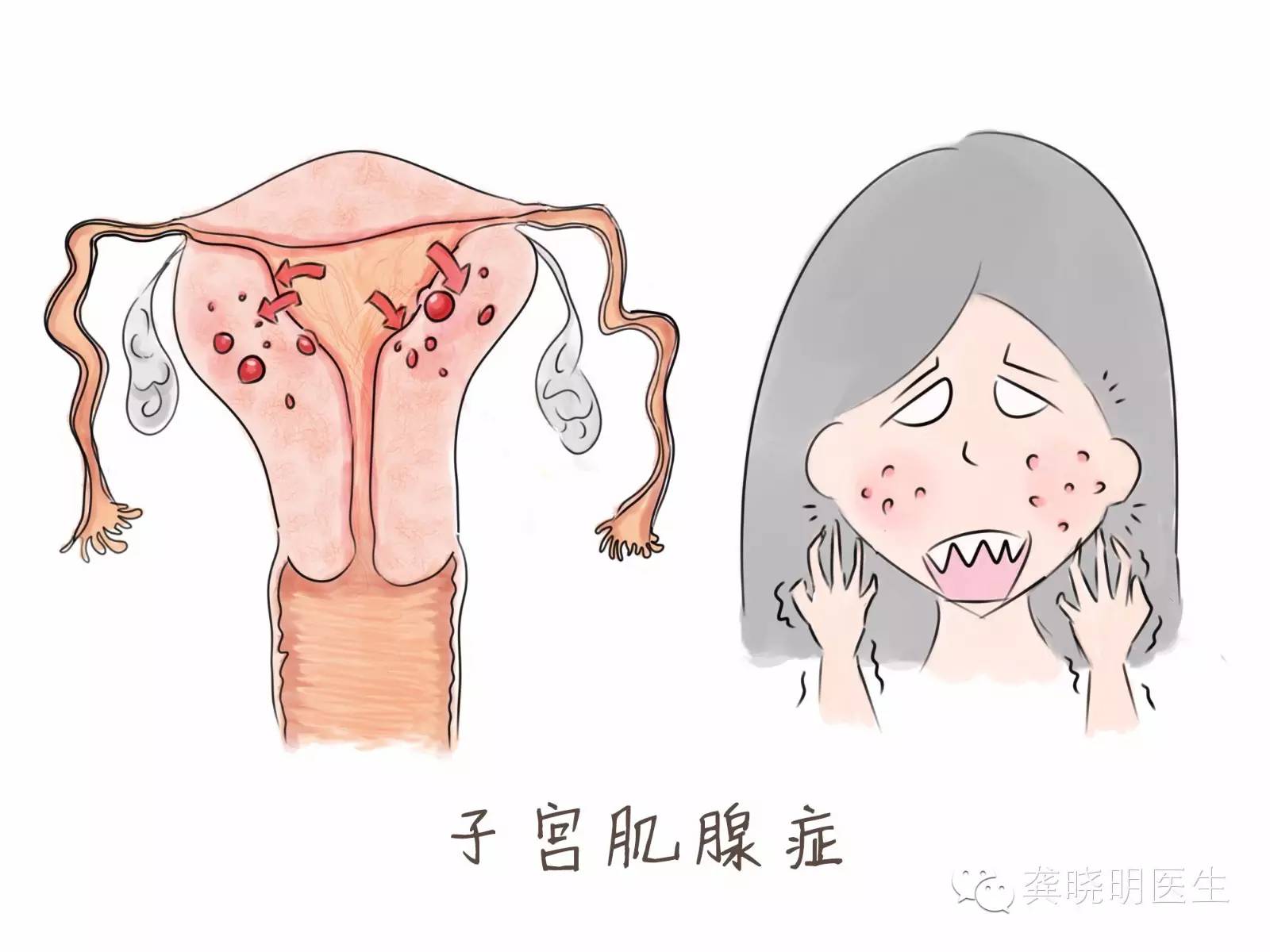 什么是子宫腺肌症_子宫腺肌症_子宫腺肌症的症状