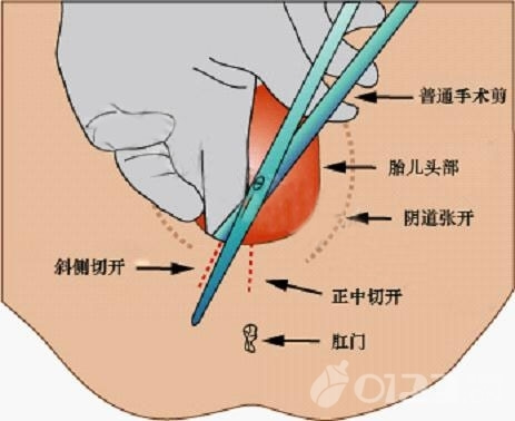 顺产侧切伤口_侧切线头_侧切