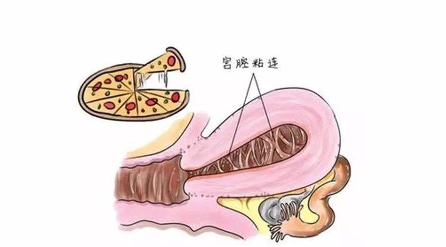 宫腔粘连