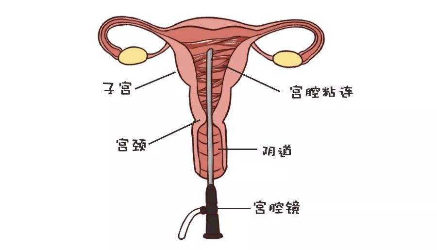 宫腔粘连