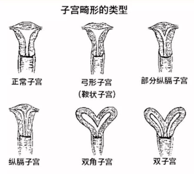 我的第二次剖宫粘连的肠子掰开_宫腔粘连术后怎样防止在次粘连_宫腔粘连